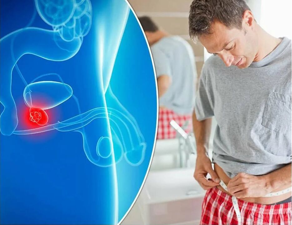 Sintomi e cause dell'infiammazione della prostata