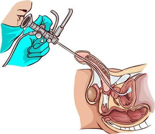 Procedura di ureteroscopia